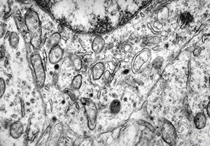 M,1y. | neuroblastoma - retroperitoneum M,1y. | neuroblastoma - retroperitoneum
